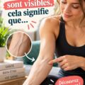 Femme avec des veines visibles sur son bras, évoquant les préoccupations de santé.
